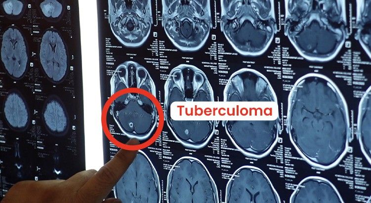 tuberculoma