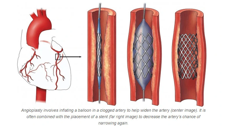 Angiography and Angioplasty